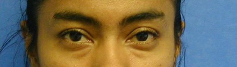 Eyelid Surgery