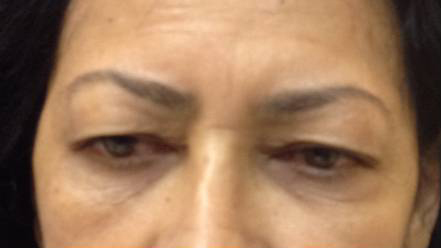 Eyelid Surgery