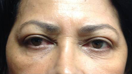 Eyelid Surgery