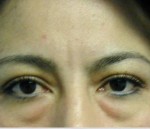 Eyelid Surgery