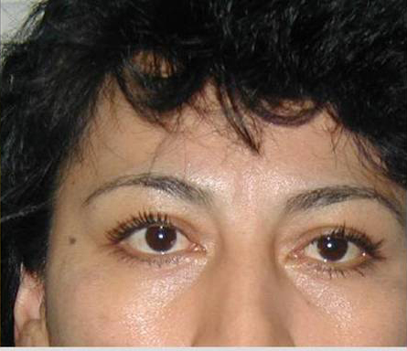 Eyelid Surgery