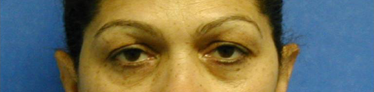 Eyelid Surgery