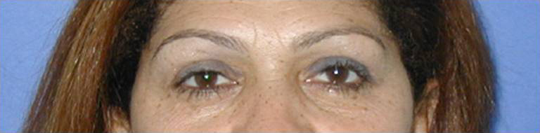 Eyelid Surgery