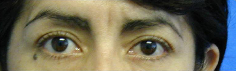 Eyelid Surgery