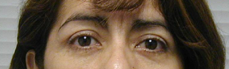 Eyelid Surgery