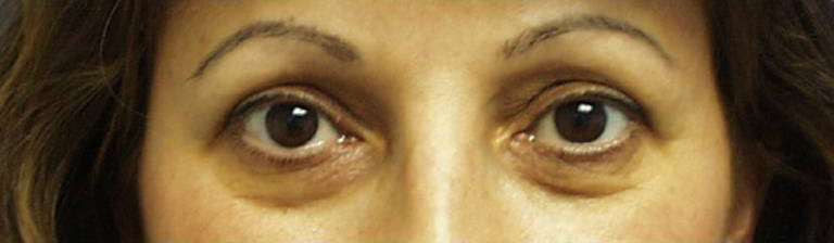 Eyelid Surgery