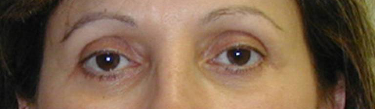 Eyelid Surgery