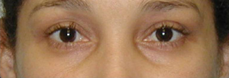 Eyelid Surgery