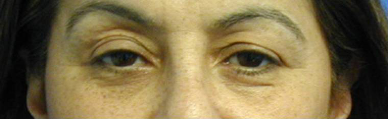 Eyelid Surgery