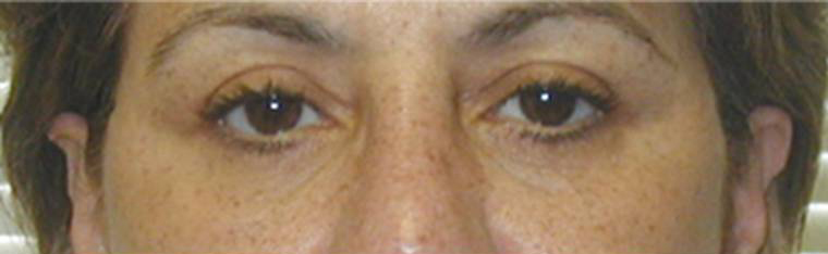 Eyelid Surgery