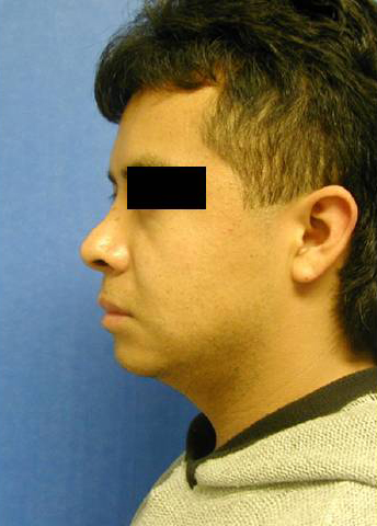 Rhinoplasty