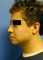 Rhinoplasty