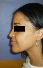 Rhinoplasty