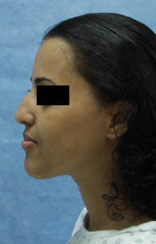 Rhinoplasty