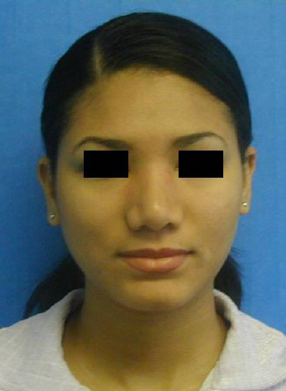 Rhinoplasty