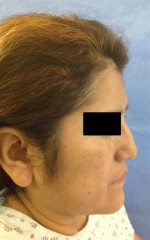 Rhinoplasty