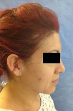 Rhinoplasty