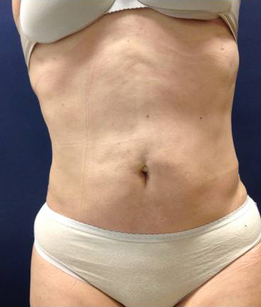 Vaser/Laser Liposculpture