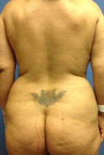 Vaser/Laser Liposculpture