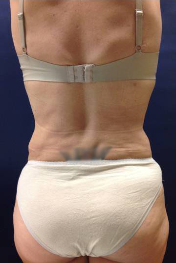 Vaser/Laser Liposculpture