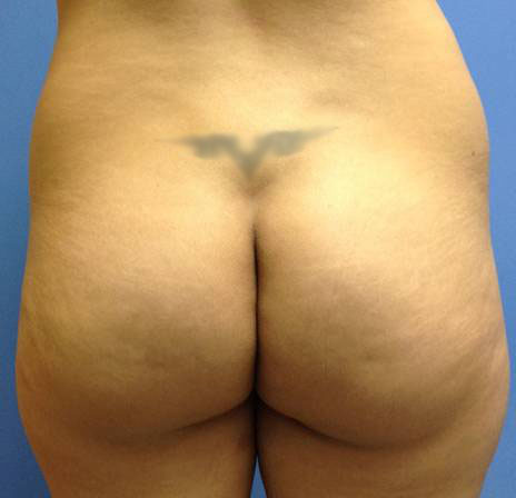 Vaser/Laser Liposculpture