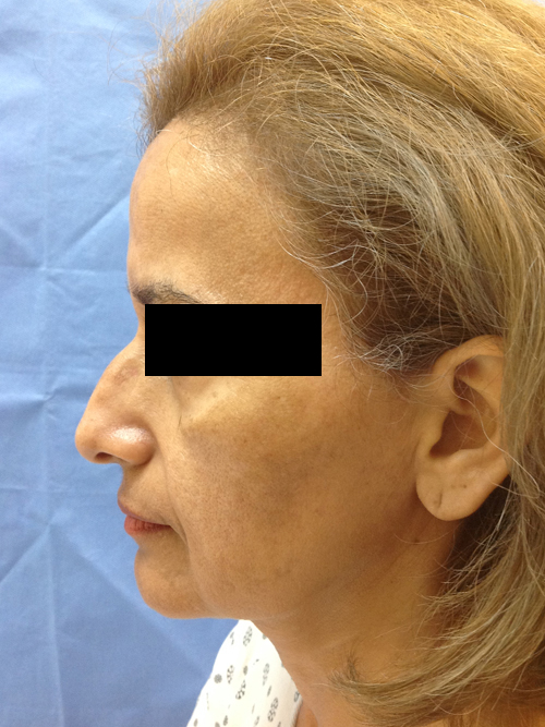 Rhinoplasty