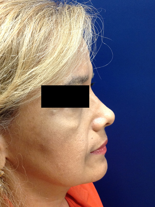 Rhinoplasty