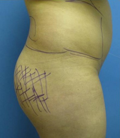 Vaser/Laser Liposculpture