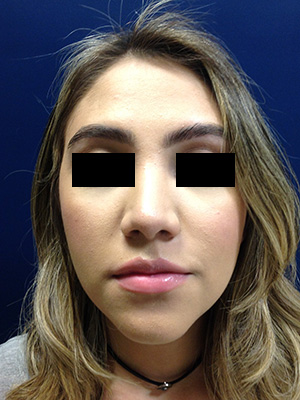 Rhinoplasty