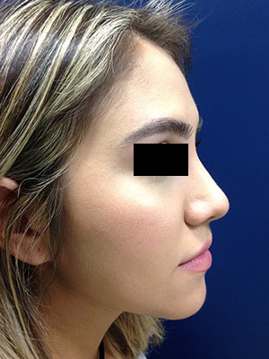 Rhinoplasty