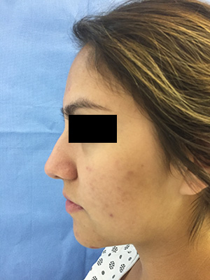 Rhinoplasty