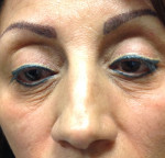 Eyelid Surgery