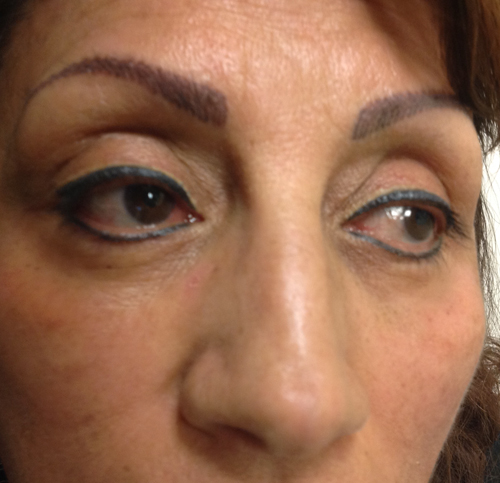 Eyelid Surgery