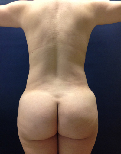 Vaser/Laser Liposculpture