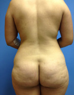 Vaser/Laser Liposculpture