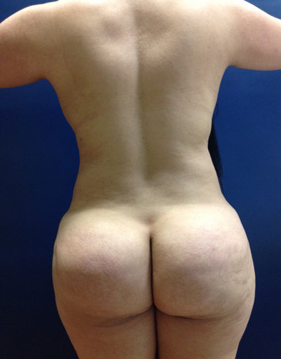 Vaser/Laser Liposculpture