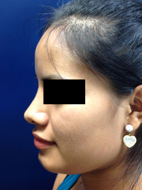 Rhinoplasty