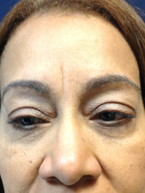 Eyelid Surgery