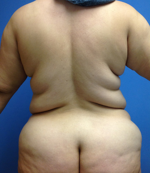 Vaser/Laser Liposculpture