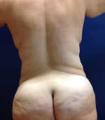 Vaser/Laser Liposculpture