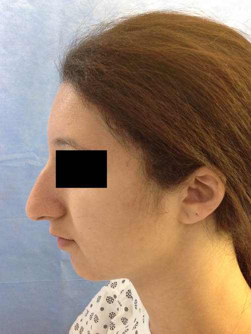 Rhinoplasty