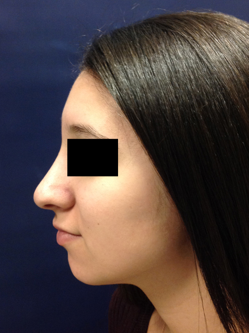 Rhinoplasty