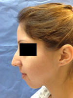 Rhinoplasty