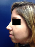 Rhinoplasty