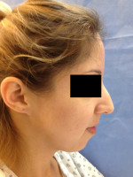 Rhinoplasty