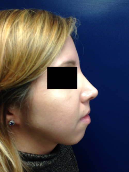 Rhinoplasty