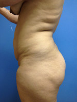 Vaser/Laser Liposculpture