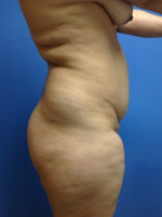 Vaser/Laser Liposculpture