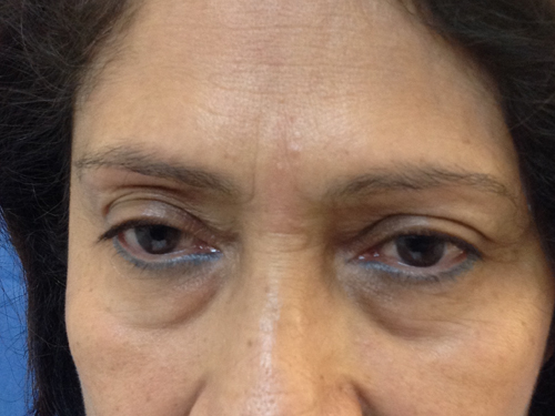 Eyelid Surgery