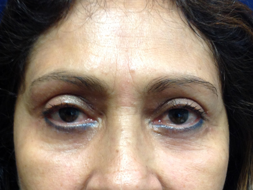 Eyelid Surgery